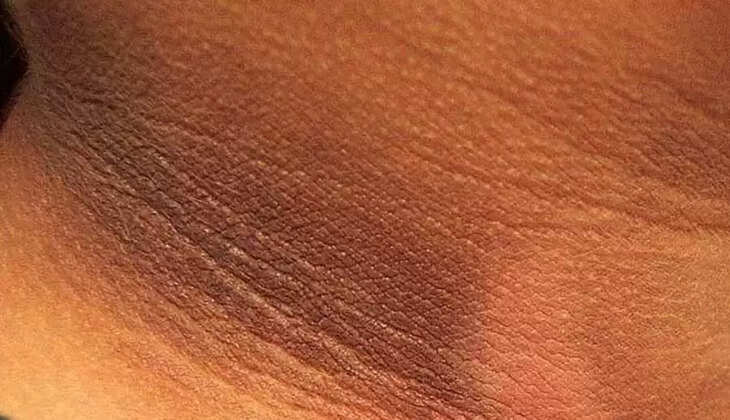 dark circles around neck