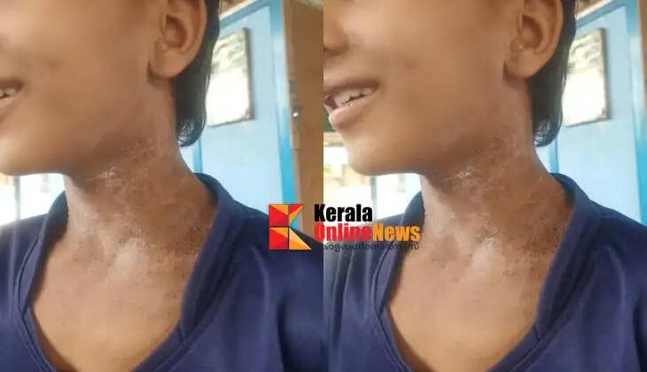 Twelve-year-old suffers from sunburn in Palakkad