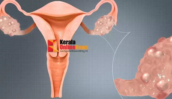 polycystic ovary syndrome