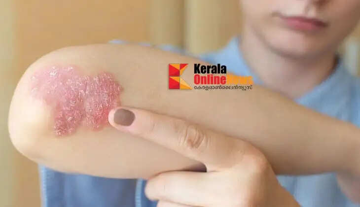 psoriasis