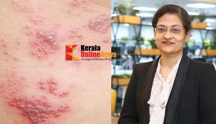 Survey finds shingles disease impact is highest among people over 50