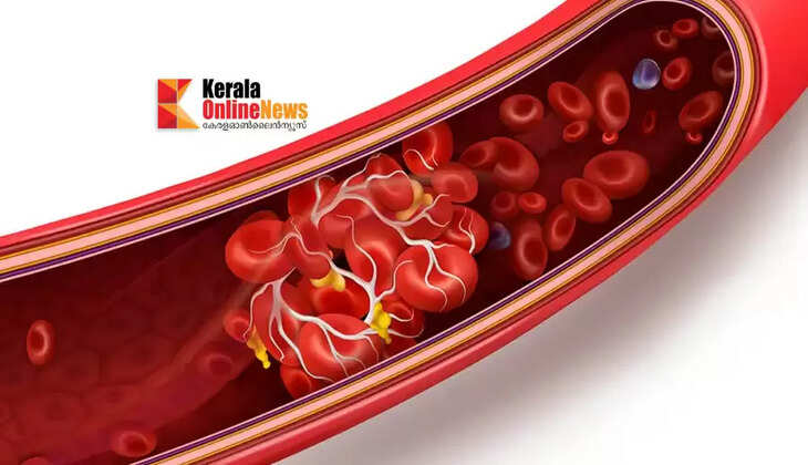 blood clots