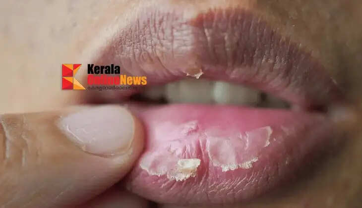 lipscrack