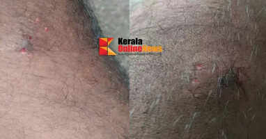 Complaint filed against KSEB employee who went to deny electricity connection in Thiruvalla, allegedly bitten by pet dog