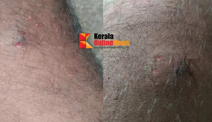 Complaint filed against KSEB employee who went to deny electricity connection in Thiruvalla, allegedly bitten by pet dog