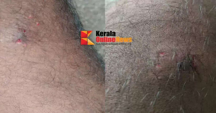 Complaint filed against KSEB employee who went to deny electricity connection in Thiruvalla, allegedly bitten by pet dog