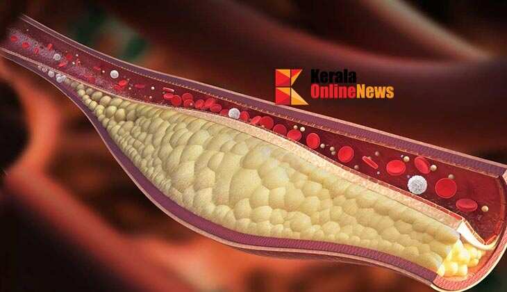 കൊളസ്ട്രോൾ പേടി മാറ്റാം; അടുക്കളയിലുണ്ട് ഈ അത്ഭുത മരുന്ന്