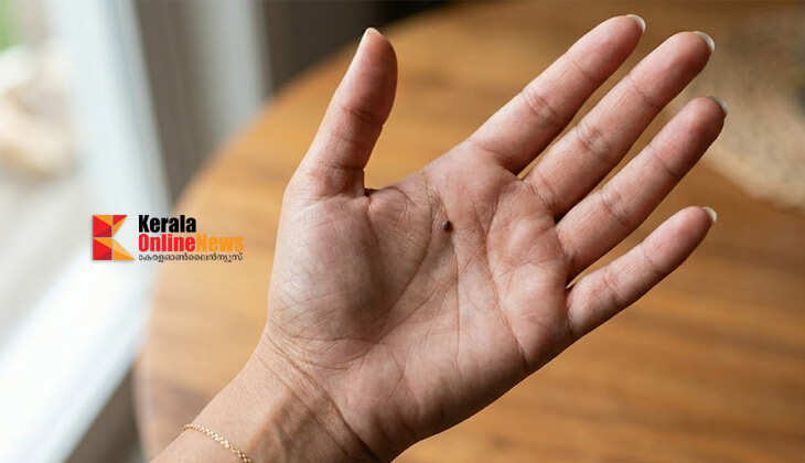 നിങ്ങളുടെ കൈവെള്ളയിൽ മറുകുണ്ടോ ? സ്വഭാവ രഹസ്യം അറിയാം